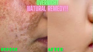 HOW TO LIGHTEN + BRIGHTEN SKIN NATURALLY OVERNIGHT | DIY At Home Face Whitening Remedy (100% WORKS)