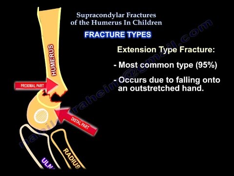 Supracondylar Fractures Of The Humerus In Children