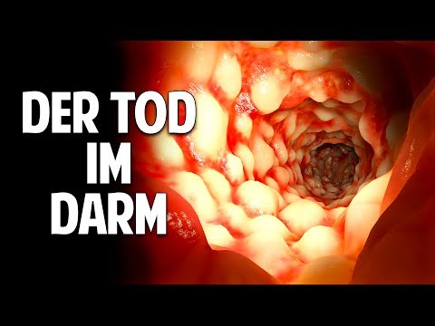 Diabetes cipher nach ICD-10 Diabetes 14ed