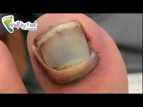 SMASHED and BLOODY TOE NAIL REMOVAL