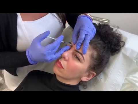 Botox injekció a péniszbe
