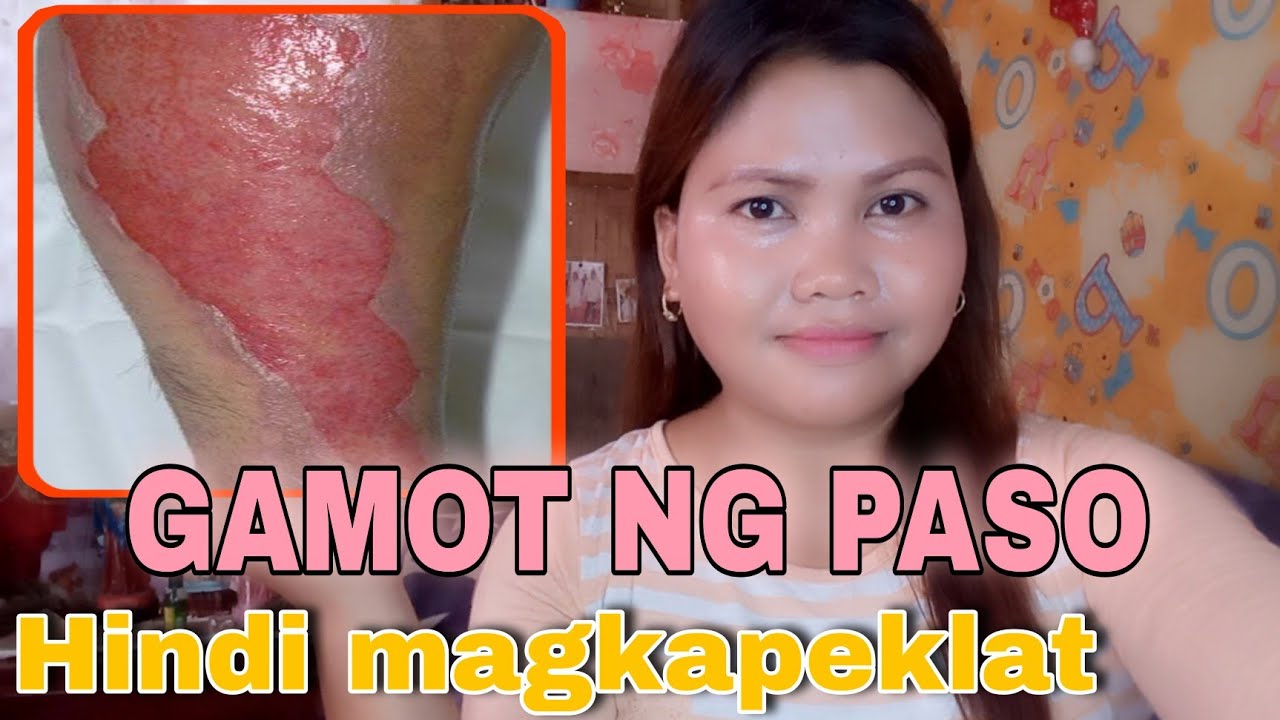 MABISANG GAMOT PARA SA PASO SA BALAT | HINDI MAGKAKA PEKLAT
