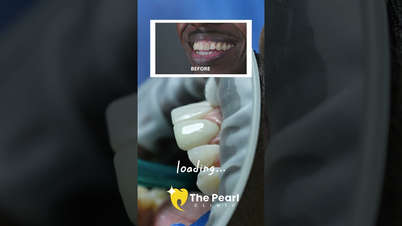 Conposite Bonding - Video