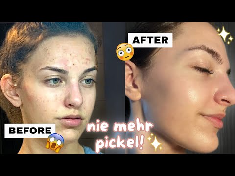 THIS is how you get clear skin ✨- skincare routine, summer glow up tips