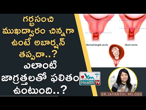 గర్భసంచి ముఖద్వారం చిన్నగా ఉంటే ఇబ్బందులు | Short cervix during pregnancy