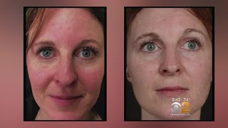 Health Watch: New Laser Treatment For Rosacea