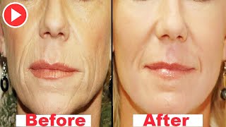 How To Remove Mouth Wrinkles In 3 Days - Lift Corners Of Your Mouth Naturally -  Remedies One
