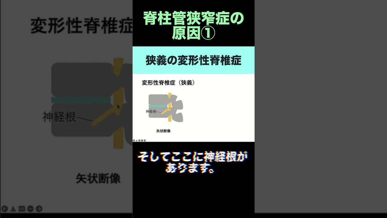 狭義の変形性脊椎症(脊柱管狭窄症とその原因①)【頸椎MRI/腰椎MRI画像診断のコツ】#shorts