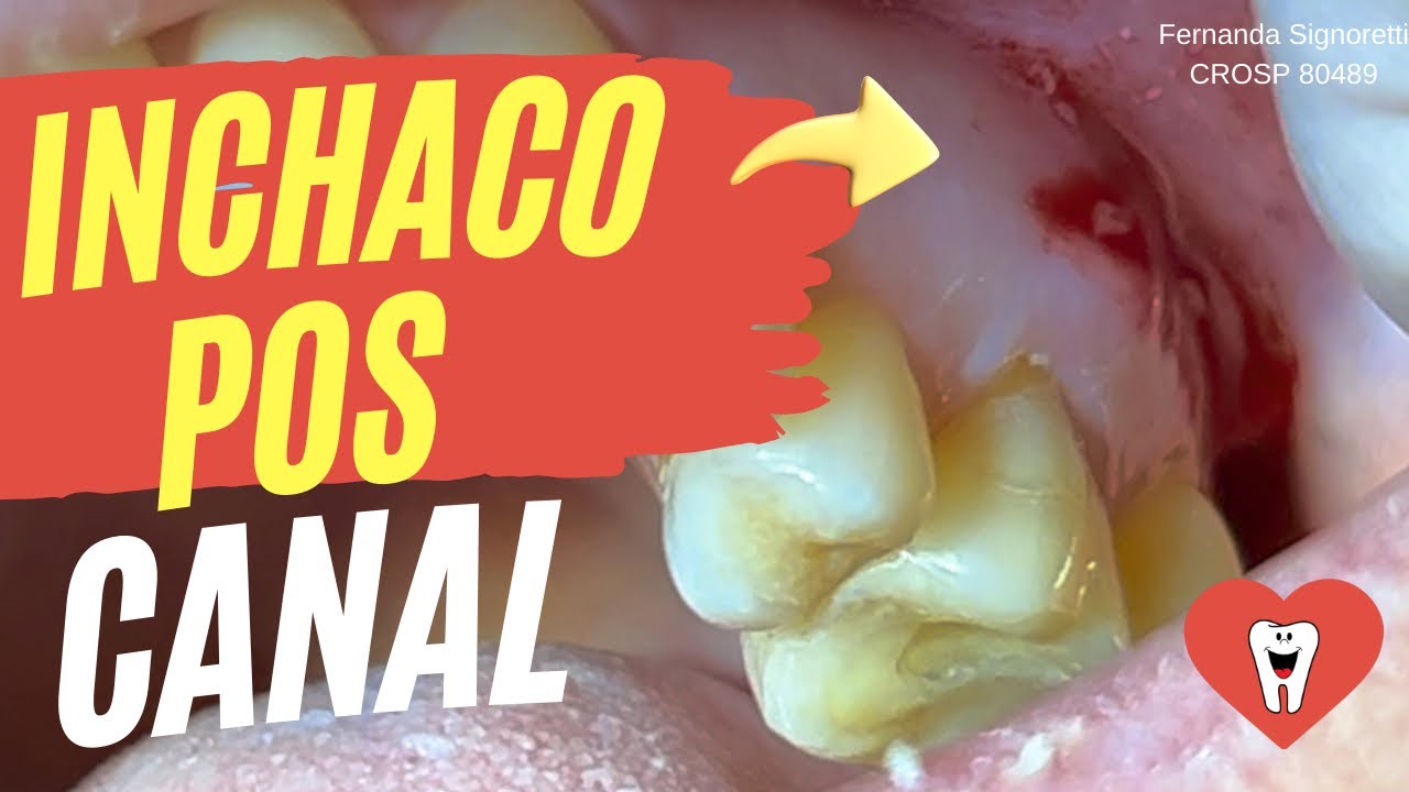 FLARE-UP NA ENDODONTIA: O QUE É E COMO EVITAR? - Endolovers