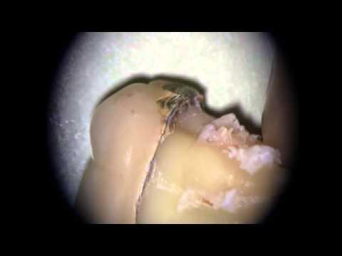 Undichte Zahnkronen sehen so aus