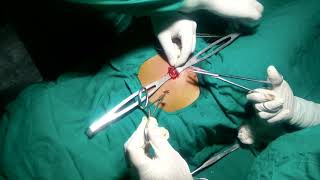 Mini laparotomy without pain for tubal ligation...