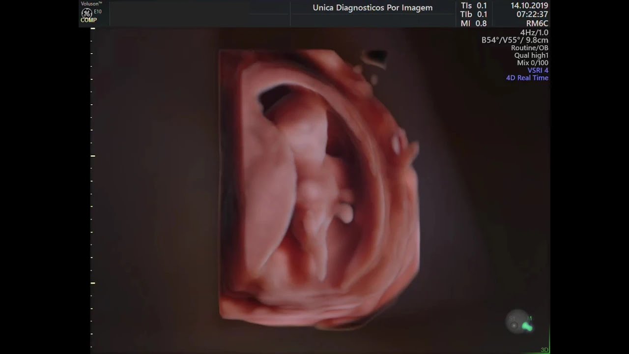ECOGRAFIA OBESTETRICO 3D EM FETO DE 12 SEMANAS E 03 DIAS
