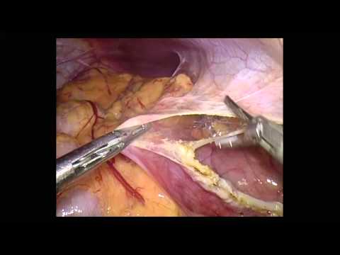 Resección laparoscópica de un quiste mesentérico gigante