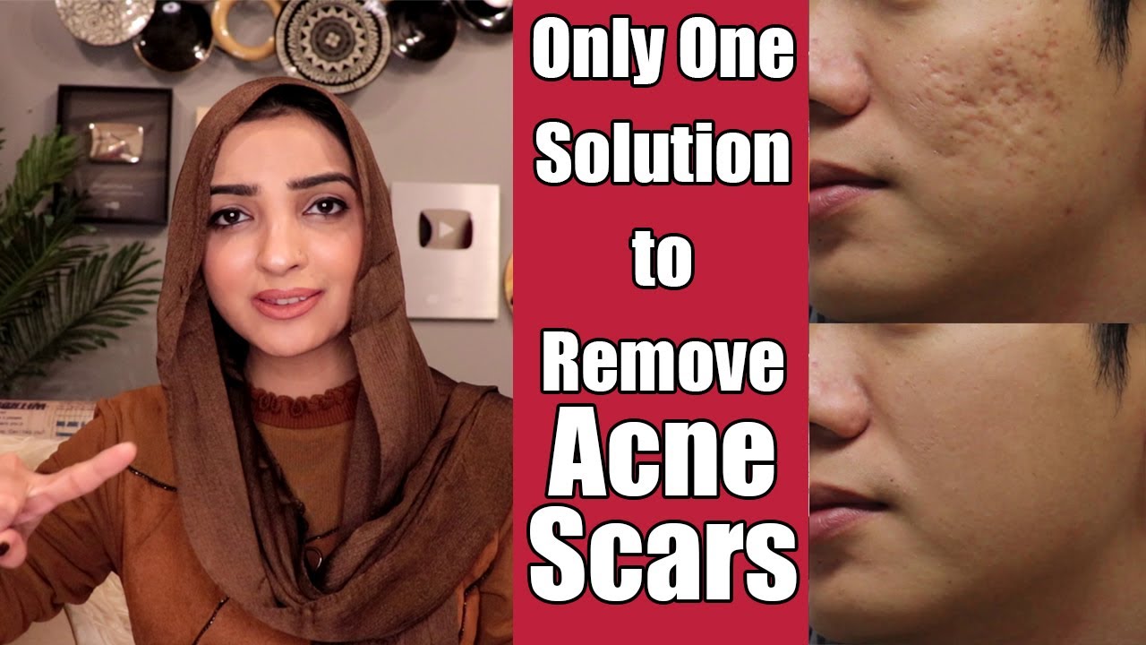 REMOVE FACE SCARS, ACNE SPOTS & PIMPLES MEDICATED GEL REVIEW