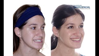 Cirugía ortognática bimaxilar. Caso #18: Sandra - Clase 3