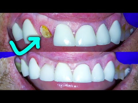 Broken Front Tooth Repair By A Dentist! How to Fix a Crown Fractured at Gumline!