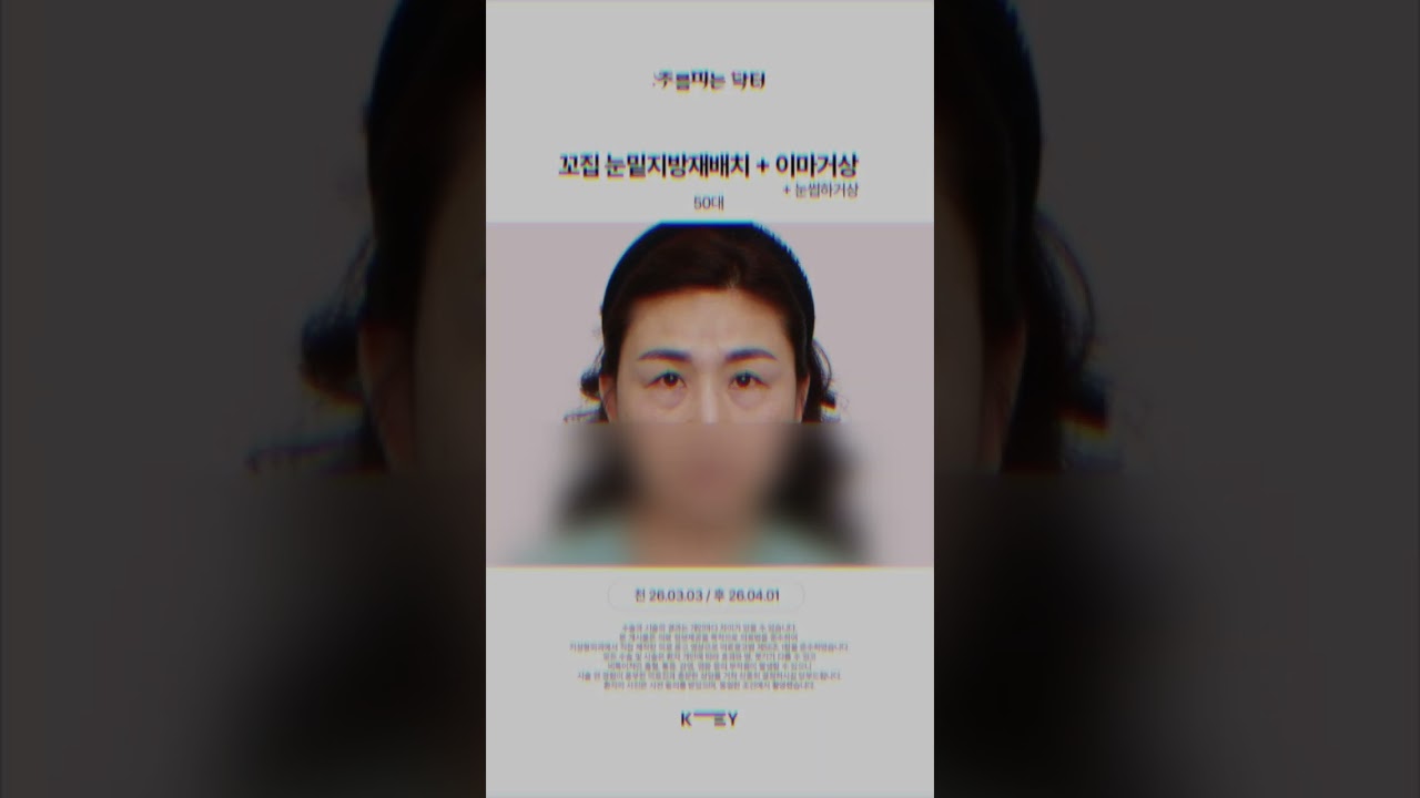 50대 눈주변(눈밑+눈위)