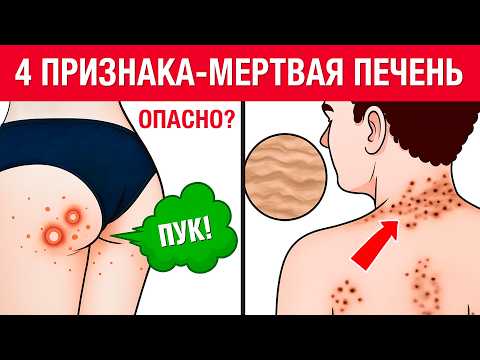 6 главных признаков УМИРАЮЩЕЙ ПЕЧЕНИ! Как быстро проверить здоровье печени?