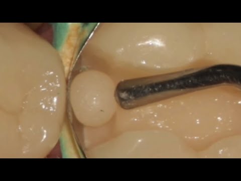 Proximal Restoration in Posterior Tooth