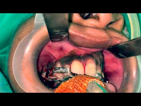 Anterior Maxillary Distraction