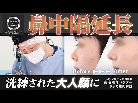 「鼻中隔延長」って何？？効果や適応は？シミュレーション方法も公開！