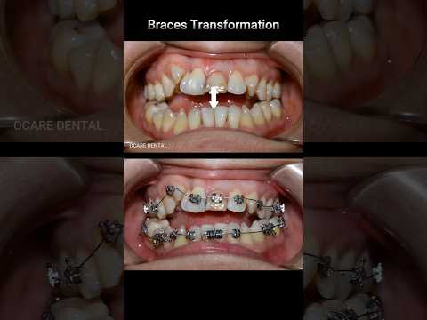 , title : 'Braces transformation - open bite & crooked teeth #braces #dentist #orthodontist #dental'