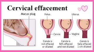 cervical effacement