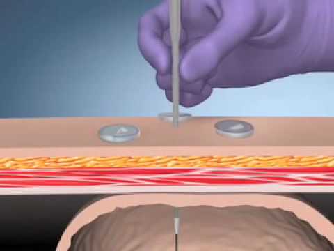 Kimberly-Clark MIC-KEY* G Introducer Kits - Endoscopic Placement