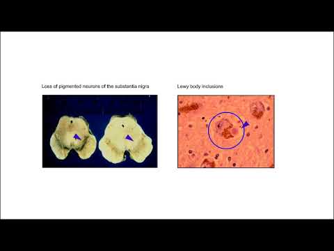 Genetic Discovery to Therapeutic Target