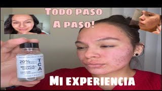 trying tca peel at home for the first time el ácido químico para acné/cicatrices.