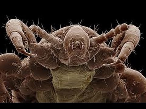 Kopfläuse / Was hilft wirkich dagegen ?