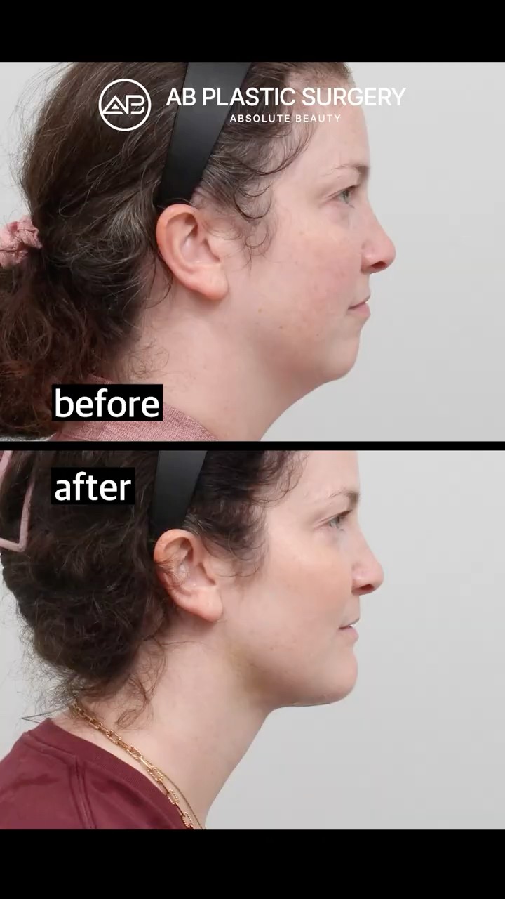 Chin Advancement+Double Chin Gone