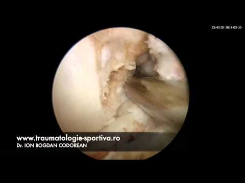 Ruptura de ligament încrucișat anterior