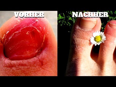 Volkseigen das Mittel die Behandlung der Nägel Gribok die Füsse vom Laser