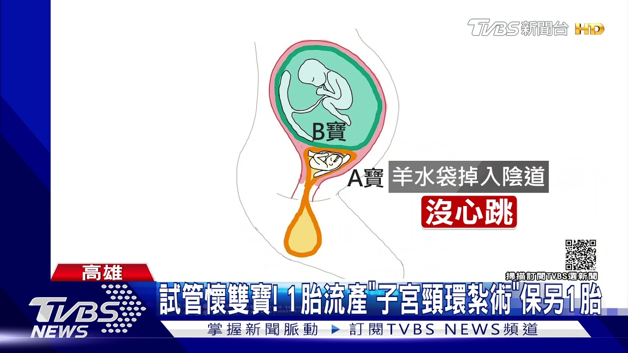 高齡產婦試管懷雙寶 1胎流產「子宮頸環紮術」保住另1胎