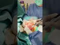 Plastic Surgeon G Samulenas Removing Breast Implants For A Patient With Capsular Contracture