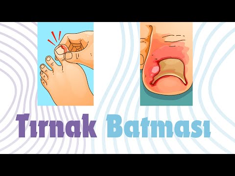 ingrown-nail-surgery