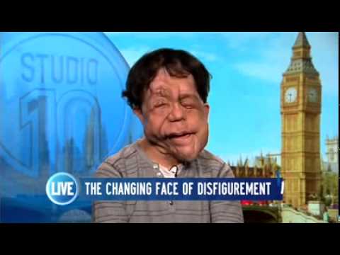 Adam Pearson talk Under the Skin and Scarlett Johansson on Studio 10