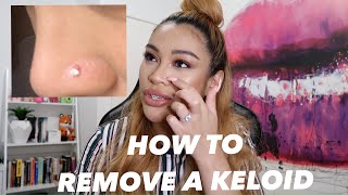 HOW I REMOVED MY NOSE PIERCING BUMP (KELOID) FAST!
