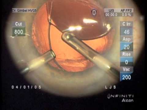 Managing A Subluxated Sulcus IOL