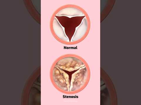 Heart valve stenosis #heart #heartvalves #stenosis #cardiology #shorts