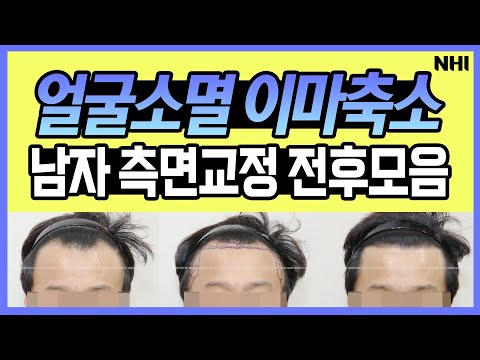 얼굴소멸! 이마축소! 남자 측면교정 헤어라인 모발이식 전후 총 모음! ㅣ뉴헤어