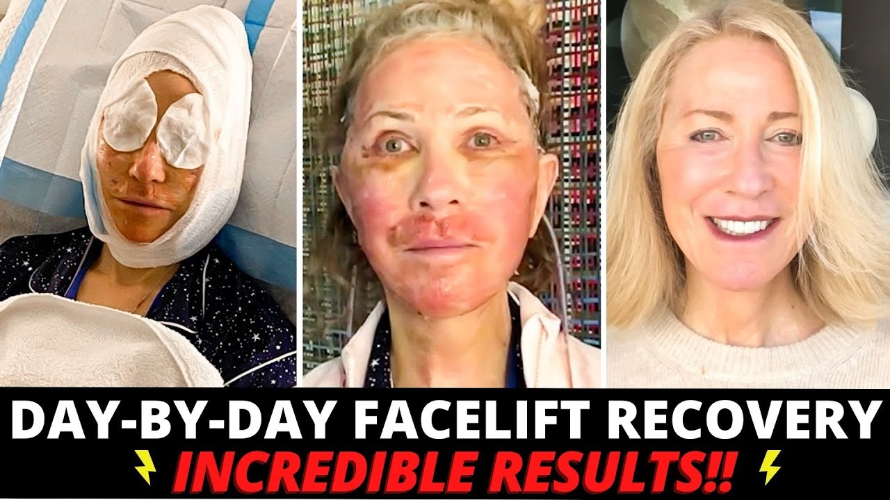Watch video 68 Year Old Undergoes Incredible Facial Plastic Surgery Transformation (Day by Day Healing Process) Now 68 Year Old Undergoes Incredible Facial Plastic Surgery Transformation (Day by Day Healing Process)