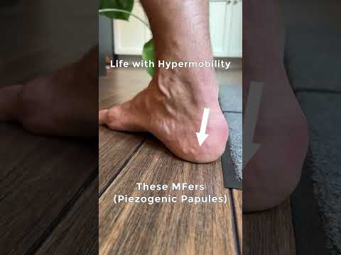 Life with hypermobility and Ehlers Danlos related symptoms #flexibility