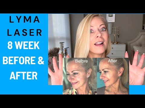 AMAZING 8 Week Lyma Laser Results:My Honest Insight Into Why Its Better Than LED #sponsored by Lyma