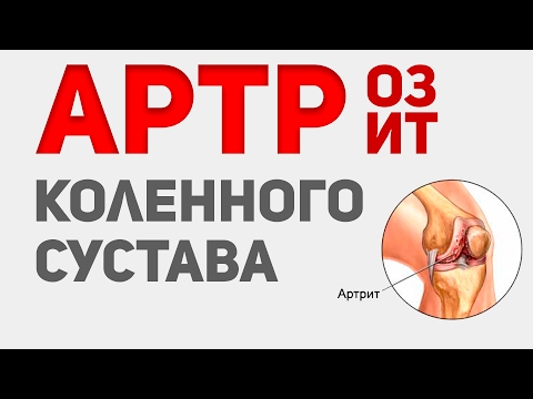 Quando la sporgenza della colonna cervicale può essere il tinnito La più potente analgesico per il dolore alla schiena
