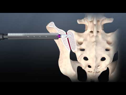 Liberty SI Lateral Implant System; a transfixing, lateral sacroiliac (SI) joint fusion system.