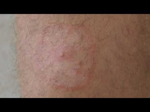 Cream Lotseril pagtuturo sa review na presyo Toenail fungus folk pamamaraan