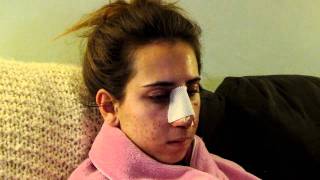 Revision Rhinoplasty Recovery: #2