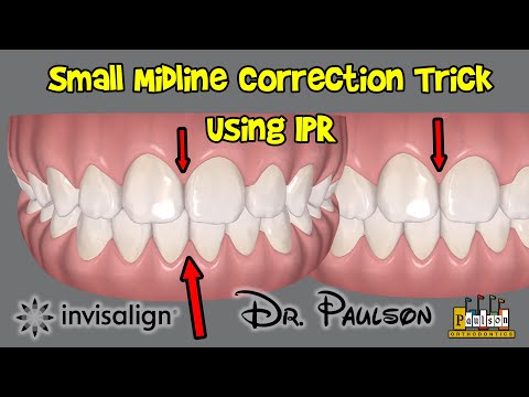 Midline Trick using IPR and Invisalign - Paulson Orthodontics